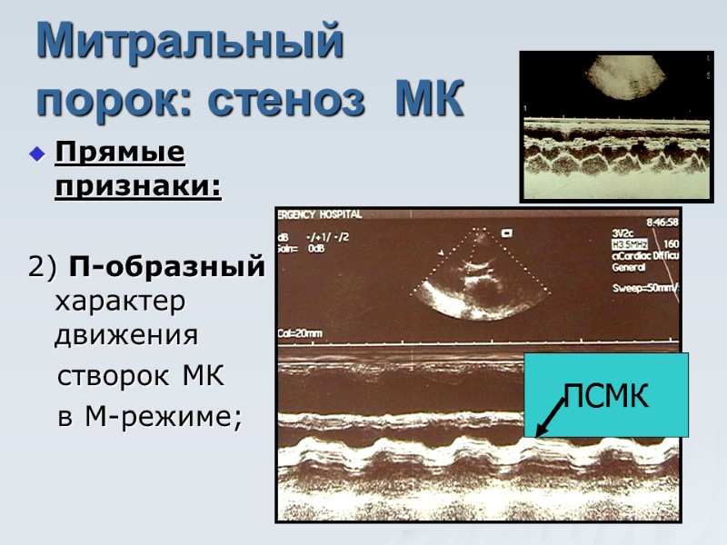 Митральный порок: стеноз  МК Прямые признаки:  2) П-образный характер движения  